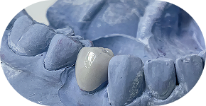 Partial dentures